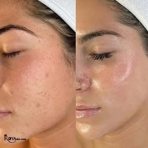 اگر جای جوش، منافذ باز، لک‌های پوستی یا خطوط ریز صورت باعث شده‌اند پوست شما شادابی و یکدستی گذشته را نداشته باشد، میکرونیدلینگ می‌تواند یکی از مؤثرترین روش‌های جوانسازی پوست برای شما باشد. 