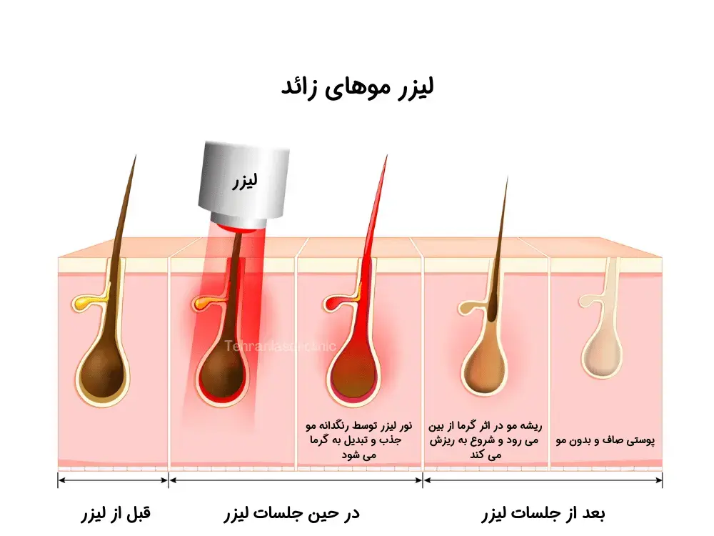 لیزر موهای زائد چیست؟ لیزر موهای زائد چیست؟