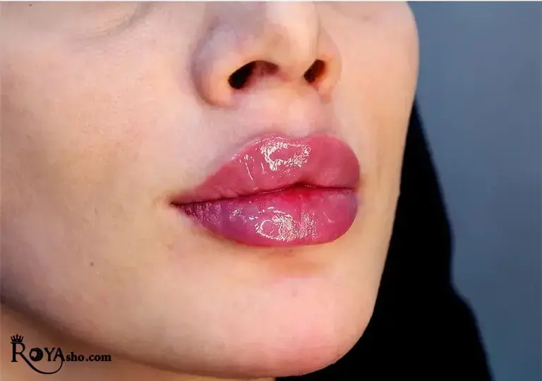 عوامل تعیین‌کننده هزینه تزریق ژل