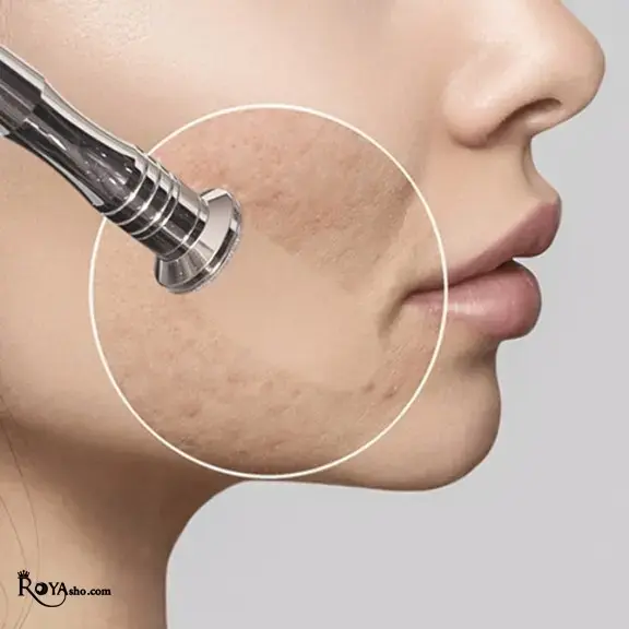 میکرودرم ابریژن یکی از روش‌های غیرتهاجمی و مؤثر در جوانسازی و پاکسازی پوست است که با هدف لایه‌برداری سطحی و بهبود کیفیت پوست انجام می‌شود.