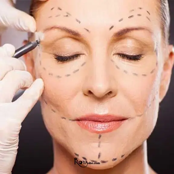 لیفت صورت یا Face Lift یکی از روش‌های مؤثر در جوانسازی و بازگرداندن فرم طبیعی و شاداب به چهره است که با هدف کاهش افتادگی پوست و اصلاح خطوط ناشی از افزایش سن انجام می‌شود. 